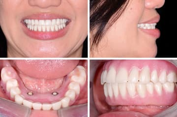Immediate Implants on Mandible and Teeth All-On-4 — dental implants case by Dr. Antipov in Roseville, CA