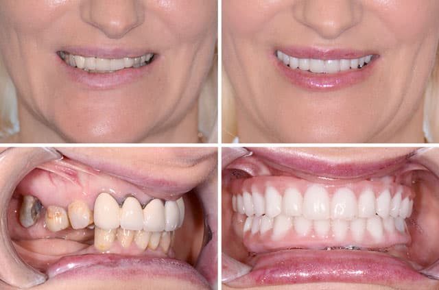 Immediate Implants and Teeth All-On-4 Surgical Case — dental implants case by Dr. Antipov in Roseville, CA