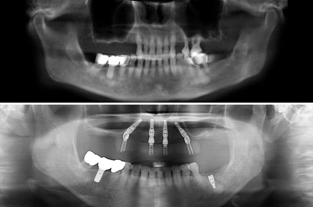 Immediate Implants and Teeth All-On-4 on Upper Jaw — dental implants case by Dr. Antipov in Roseville, CA