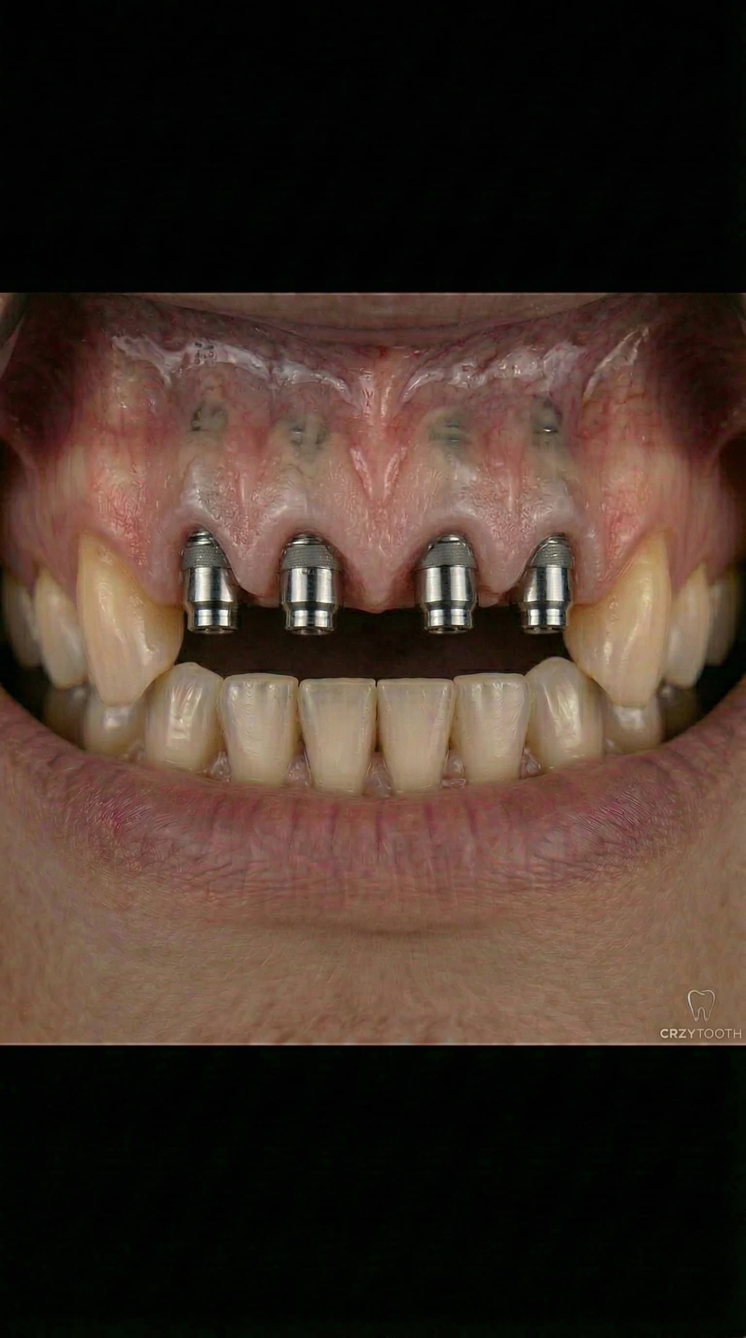 Full-arch implant abutments during treatment