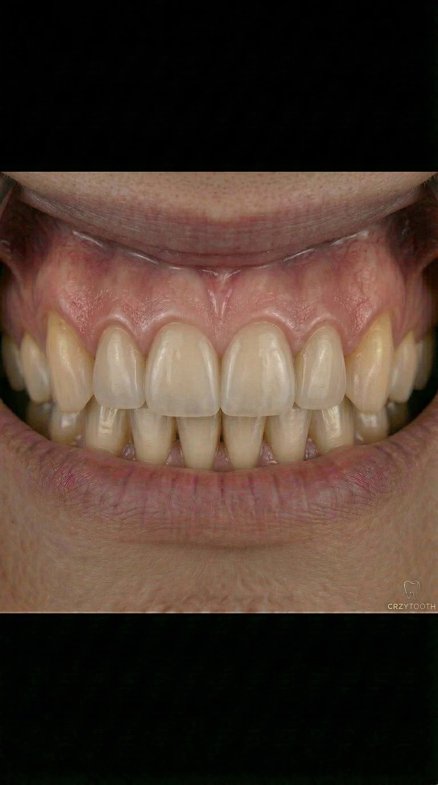 Full-arch implant final result