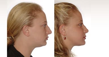 Corrective Jaw Surgery — Orthognathic Surgery, Le Fort, BSSO & Genioplasty — Dr. Alexander Antipov, Oral Surgeon, Roseville CA