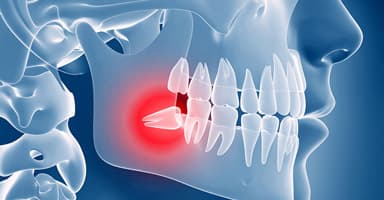 Bone Grafting & Sinus Lifts — Organic, Holistic & Autogenous Bone Regeneration — Dr. Alexander Antipov, Oral Surgeon, Roseville CA