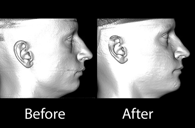 Face And Bite Correction Surgical Case Corrective Jaw Surgery Dr Antipov