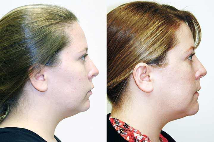 lower-jaw-and-chin-forward-corrective-jaw-surgery-dr-antipov