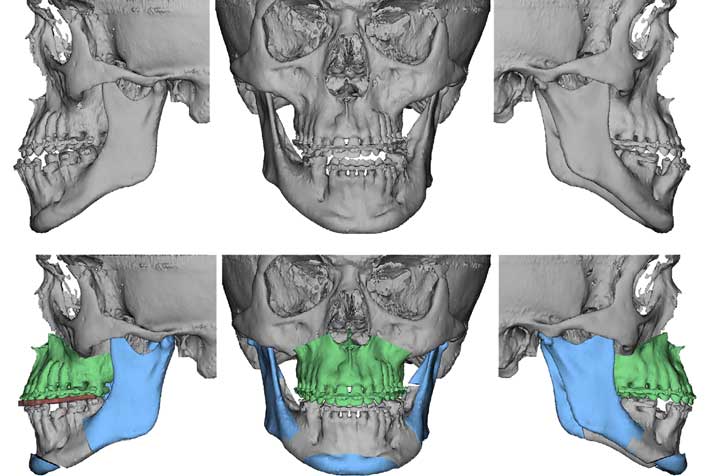 Facial Asymmetry Correction - Corrective Jaw Surgery - Dr. Antipov