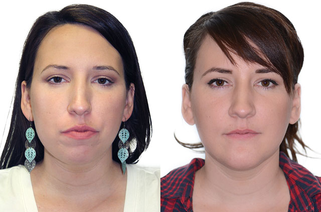 Bite And Nasal Base Correction Corrective Jaw Surgery Dr Antipov