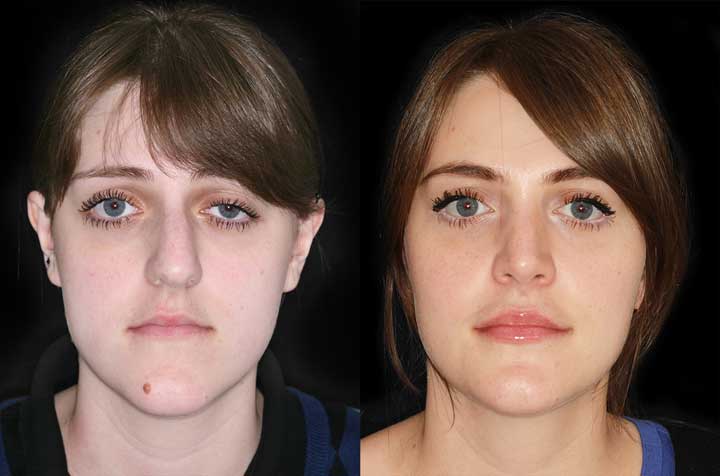 Contouring Of The Mandible Maxillary Advancement Corrective Jaw Surgery Dr Antipov