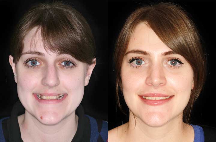 Contouring Of The Mandible Maxillary Advancement Corrective Jaw Surgery Dr Antipov