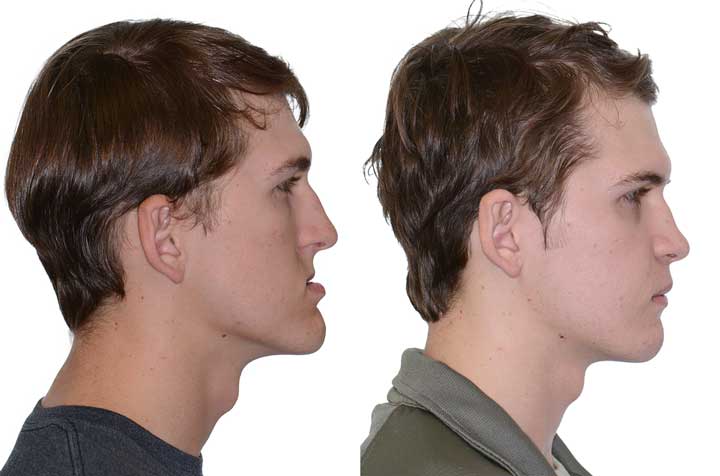 Double Jaw Orthognathic Surgery Corrective Jaw Surgery Dr Antipov