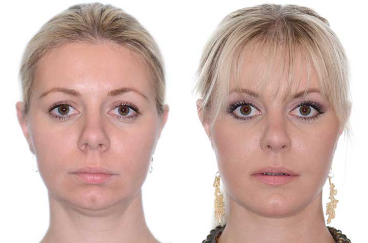 corrective-jaw-surgery-complete-face-makeover-corrective-jaw-surgery