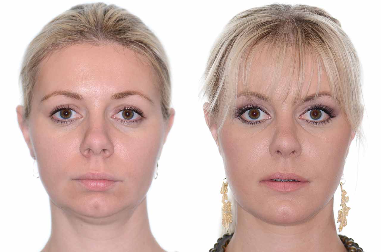 Corrective Jaw Surgery Complete Face Makeover Corrective Jaw Surgery 