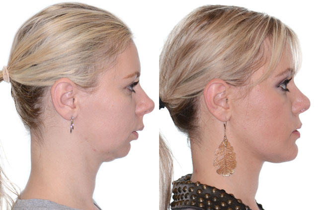 Corrective Jaw Surgery Complete Face Makeover Corrective Jaw Surgery 