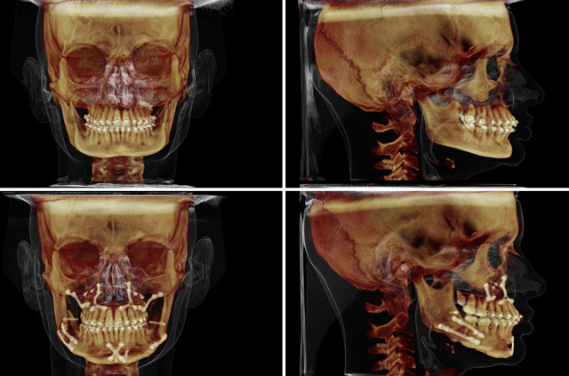 Face Lengthenning And Advancement. Aesthetic Jaw Surgery. - Corrective 