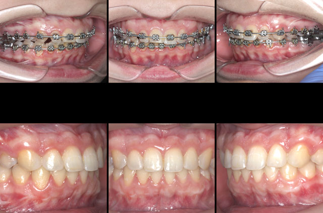 Class II Occlusion Anomaly Corrective Jaw Surgery - Corrective Jaw ...