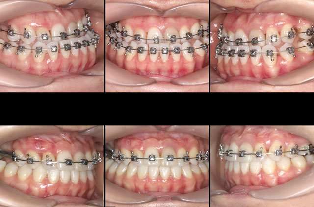 Correction of an Asymmetric Anomaly of Class II Occlusion - Corrective ...