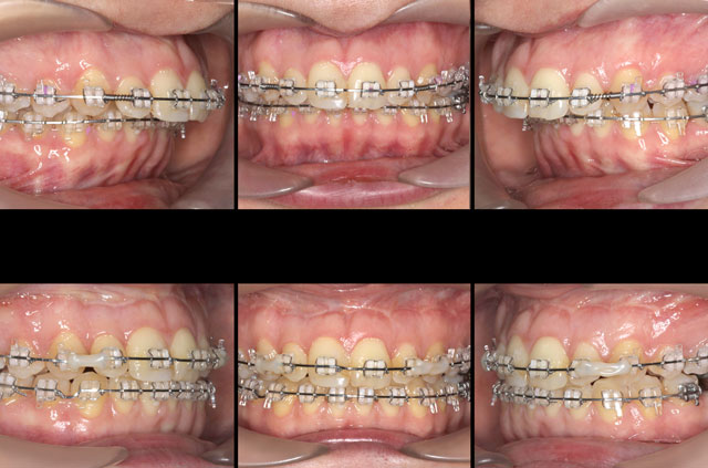 Class II Occlusion Anomaly Corrective Jaw Surgery - Corrective Jaw ...