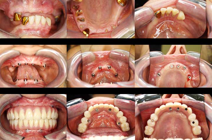 All-on-4 and Teeth-in-a-Day™ Technique - Dental Implants - Dr. Antipov