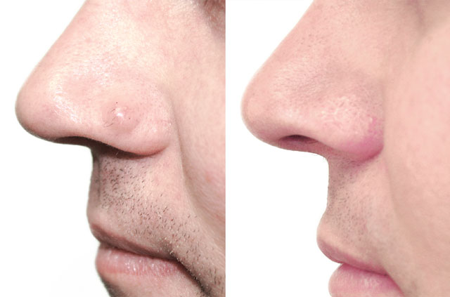 scarless-mole-removal-from-the-nose-facial-cosmetic-surgery-dr-antipov