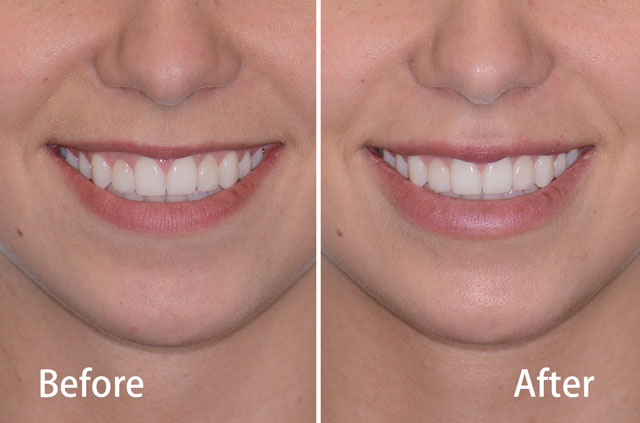 Juvederm® Lips Fillers Facial Cosmetic Surgery Dr Antipov 